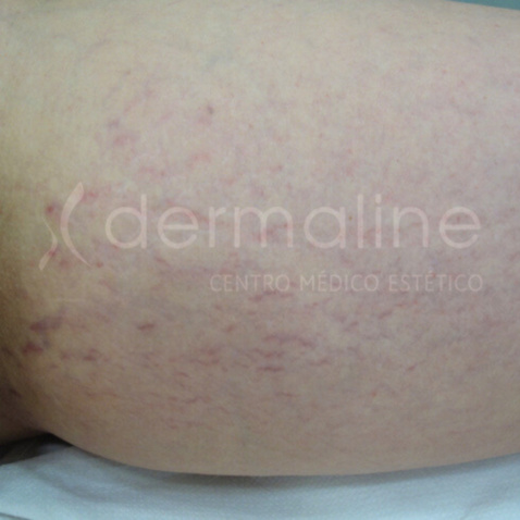 tratamiento-estrias-11-antes.jpg