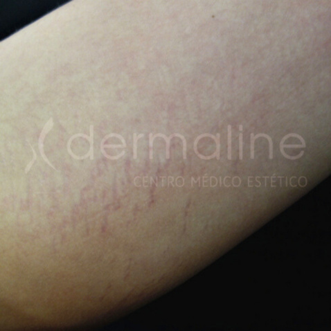 tratamiento-estrias-12-antes.jpg