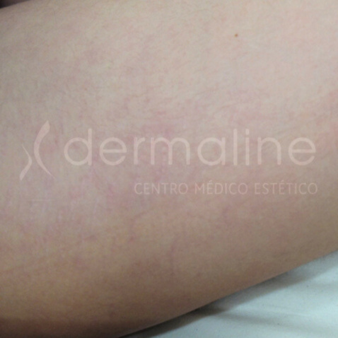 tratamiento-estrias-12-despues.jpg