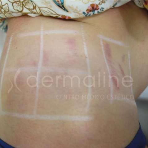 tratamiento-estrias-15-antes.jpg