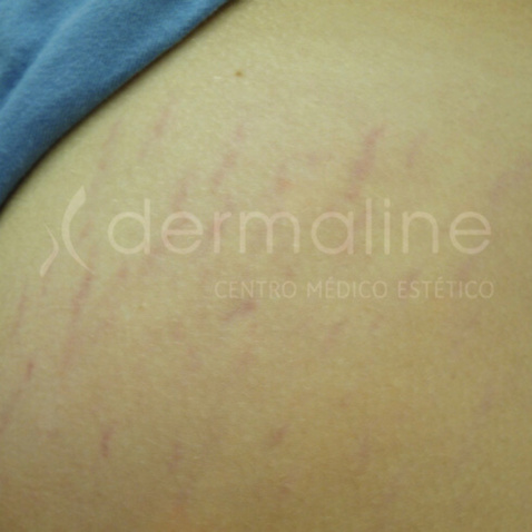 tratamiento-estrias-16-antes.jpg