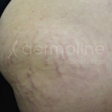 tratamiento-estrias-3-antes.jpg