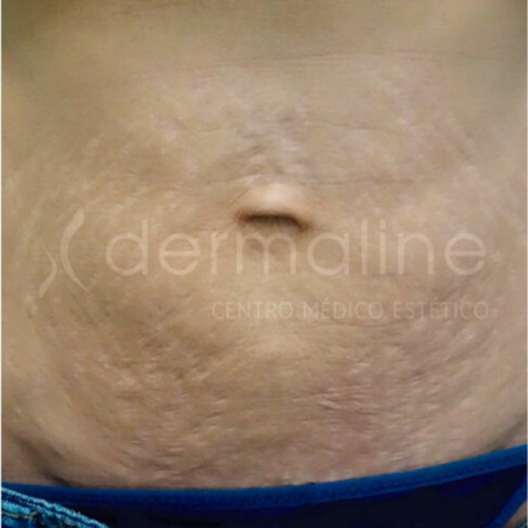 tratamiento-estrias-4-despues.jpg