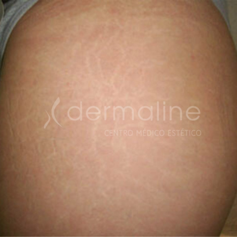 tratamiento-estrias-5-antes.jpg