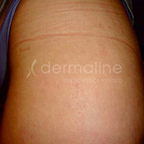 tratamiento-estrias-5-despues.jpg