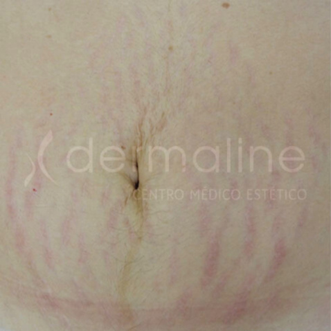 tratamiento-estrias-6-antes.jpg